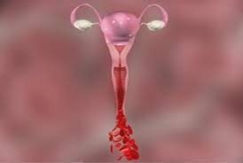 Abnormal vaginal bleeding